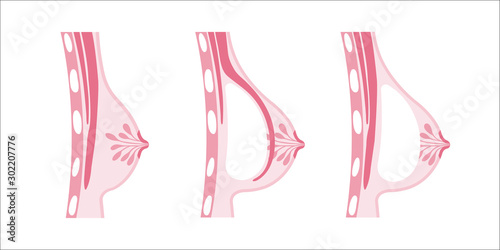 Vector illustration of breast augmentation. Plastic surgery.