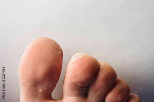 Fungus Infection on Nails of Man s Foot on white background.