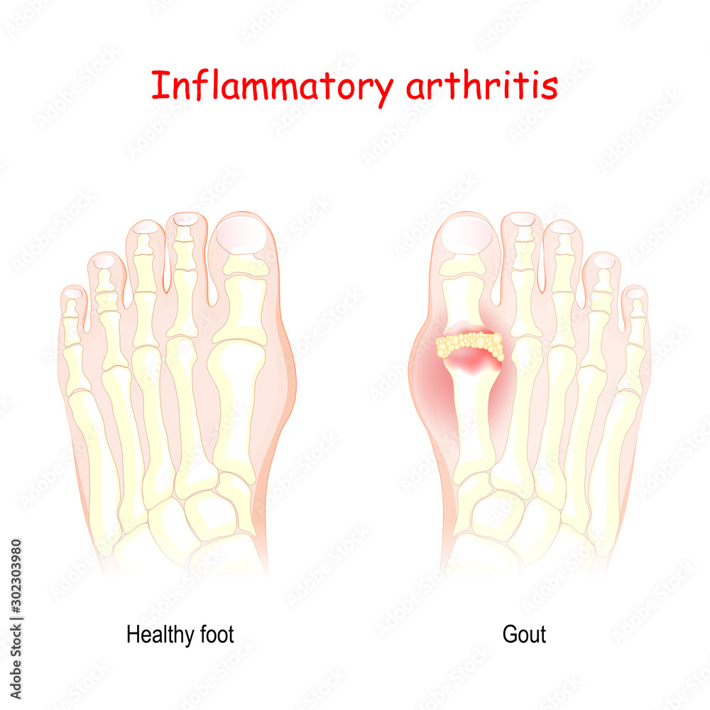 Gout. inflammatory arthritis. Stock Vector | Adobe Stock