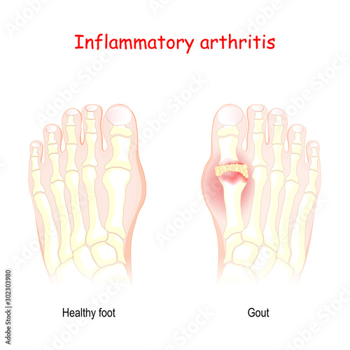 Gout. inflammatory arthritis.