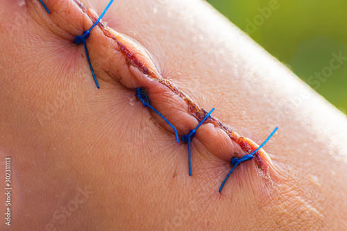 Wound with suture after surgery