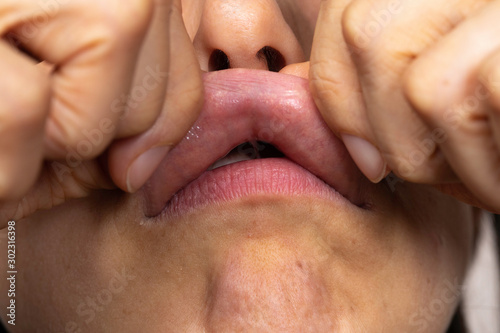 Woman showing upper lip close up view