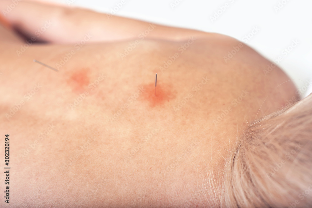 Fototapeta premium Woman on acupuncture