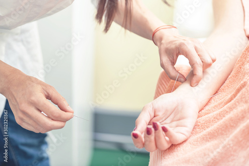 Woman on acupuncture