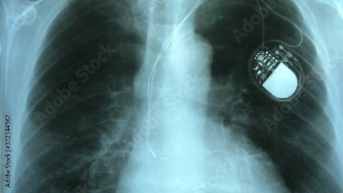 Doctor Examining X-Ray Image of Chest with Artificial Cardiac Pacemaker Implant