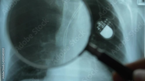 Wallpaper Mural X-Ray Image of Chest with Artificial Cardiac Pacemaker Under Magnifying Glass Torontodigital.ca