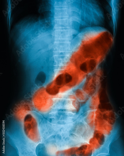 X-ray image of abdomen pain, supine position, showing Ulcerative Colitis (UC) and Peptic ulcer perforate
