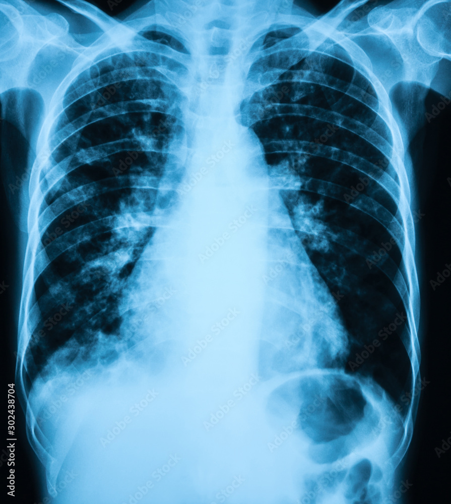 Chest X-ray image showing Pulmonary tuberculosis Chest X-ray image showing Pulmonary tuberculosis