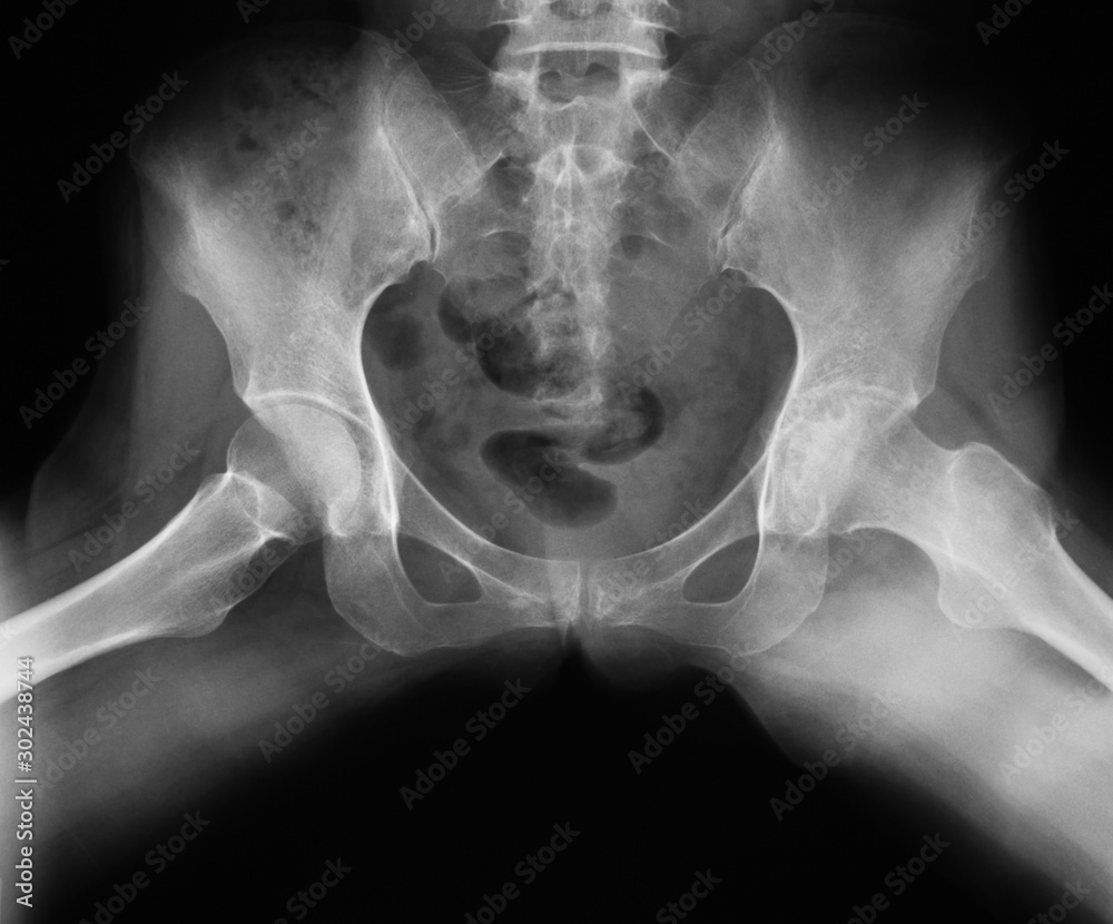 Xray image of both hip, frogleg Position, show hip osteoarthritis