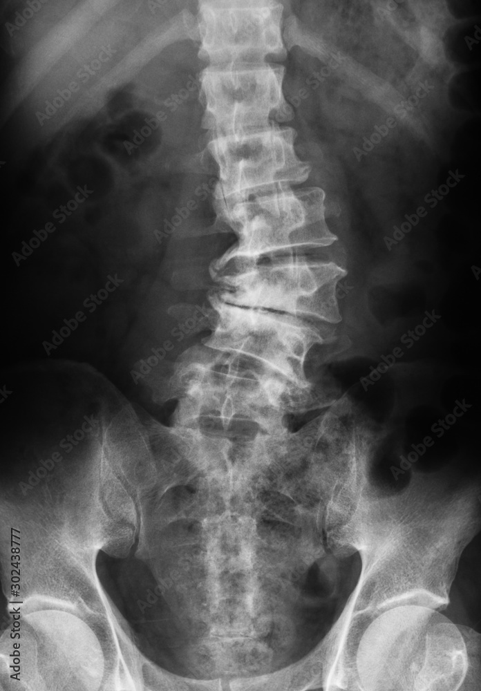 Xray image of lumbosacral spine (LS spine) showing lumbar