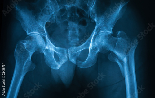 Fotografía X-ray image of the both hip showing right femoral neck fracture