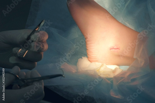 Surgeon man preparing to sew up wound on leg after surgery to removal ankle hygroma, hands closeup. Doctor holds clip with needle and thread in one hand and bandage in other. Operation in hospital.