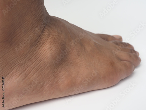 Big ganglion cysts,a sac of jellylike fluid,is on the right foot of man put on the white background.