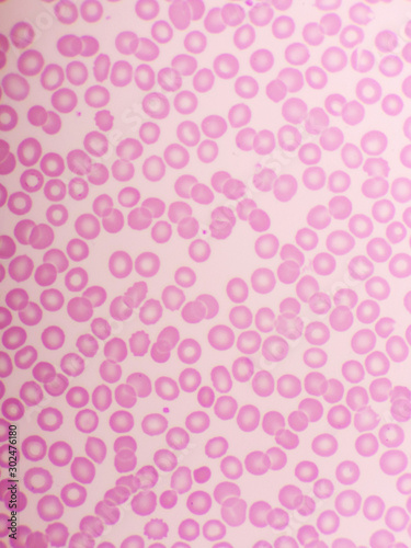 Red blood cells in blood smear, Wright-Giemsa stain, analyze by microscope, 1000x