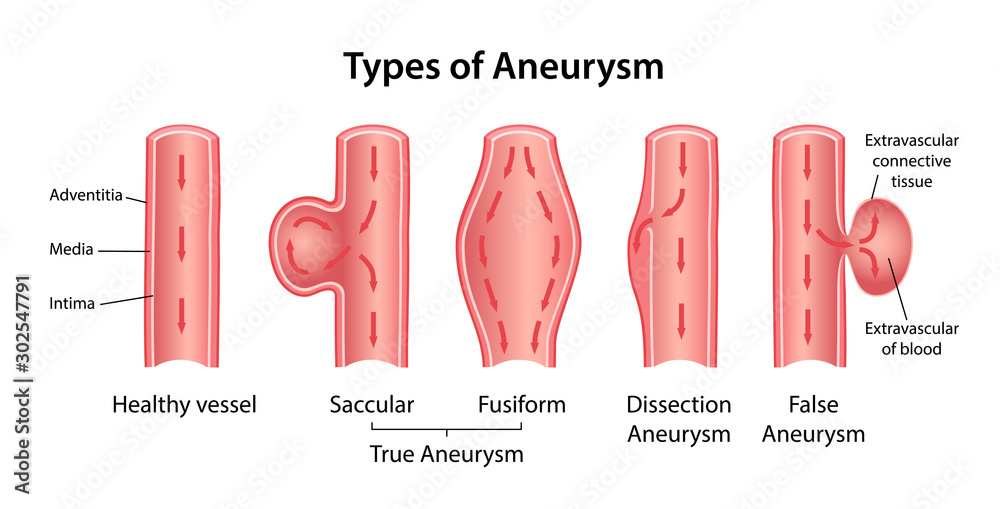 Types of aneurysm: True Aneurysm (Saccular, Fusiform), False Aneurysm and  Dissection Aneurysm. Longitudinal section of blood vessels indicating blood  flow. Vector illustration in flat style Stock-Vektorgrafik | Adobe Stock