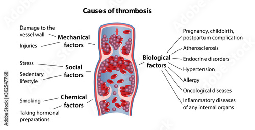 Causes of thrombosis: mechanical, chemical, biological and social causes. Vector illustration in flat style isolated on white background with main description