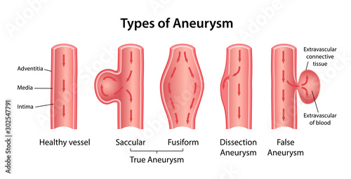 Types of aneurysm: True Aneurysm (Saccular, Fusiform), False Aneurysm and Dissection Aneurysm. Longitudinal section of blood vessels indicating blood flow. Vector illustration in flat style photo