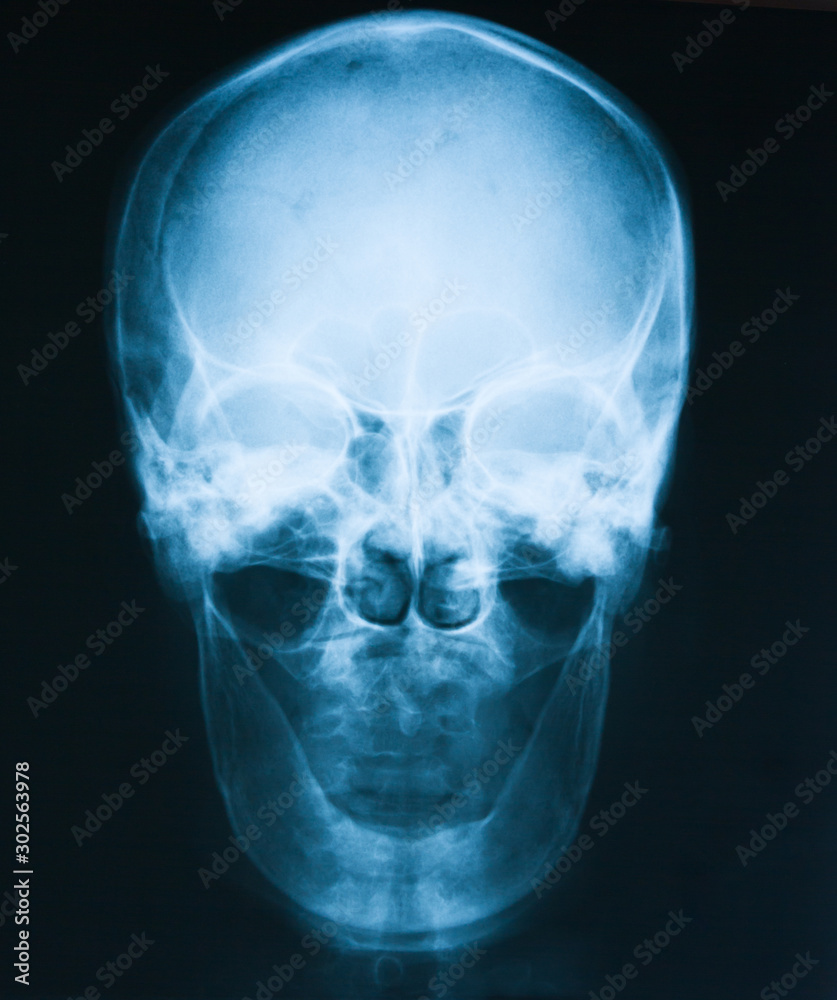 X-ray image of skull, a man loss of teeth, old man X-ray image of skull, a man loss of teeth, old man