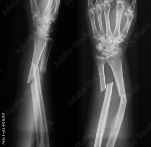 Obraz na płótnie X-ray image of broken forearm, AP and lateral view