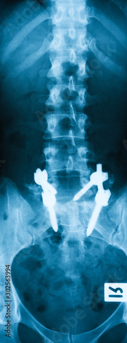 X-ray image of lumbosacral spine, anteroposterior (AP) view, Internal plate fixation of fractures