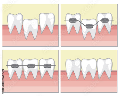 Teeth with metal braces on the gum, a vector illustration with occlusion correction for an orthodontic or dental clinic