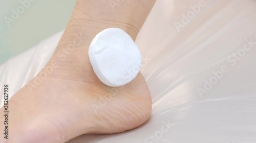 Surgeon puts cotton pads on patient's leg with suture sfter ankle hygroma removal, closeup view. Recovery, rehabilitation, therapy and treatment after operation. Wound healing with stitches. photo