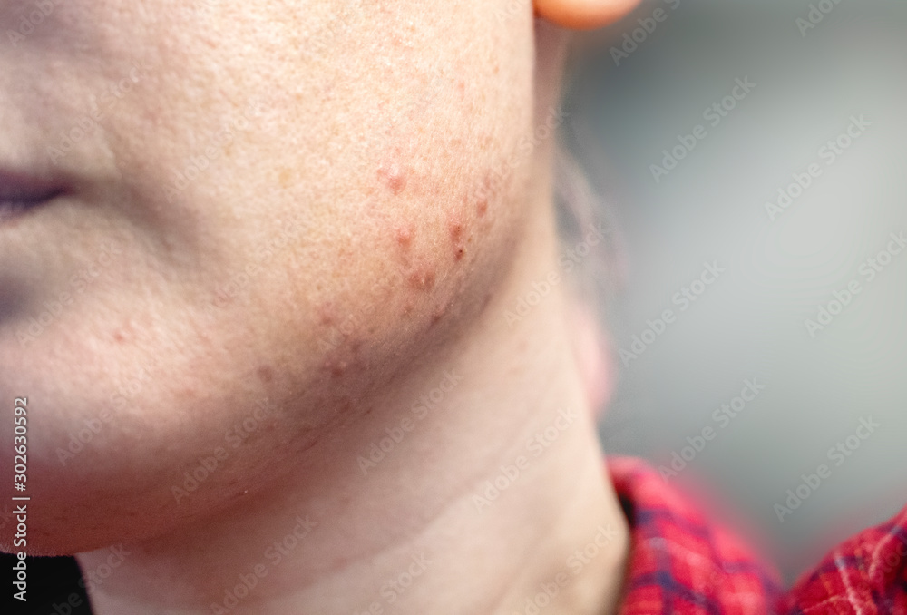 Acne on the chin: demodecosis tick on the skin of a girl's face. Patient at the appointment of a dermatologist. Problem skin and beauty concept. Acne on the chin: demodecosis tick on the skin of a girl's face. Patient at the appointment of a dermatologist. Problem skin and beauty concept.