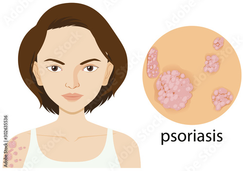 Woman with psoriasis on poster