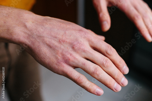 Fototapeta Naklejka Na Ścianę i Meble -  Psoriasis skin. Closeup of rash and scaling on the patient's skin. The concept of chronic disease treatment. Dermatological problems. Hard, horny and cracked skin in man's hands. Dry skin.