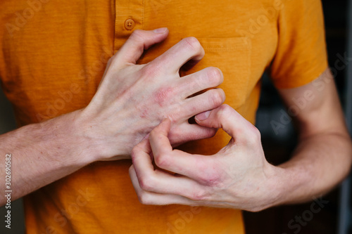 Man scratch oneself, dry flaky skin on hand with psoriasis vulgaris, eczema and other skin conditions like fungus, plaque, rash and patches. Autoimmune genetic disease.