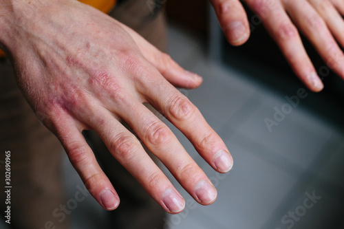 high angle view of hands suffering the dryness on the skin and deep cracks on knuckles. Eczema or psoriasis on hands