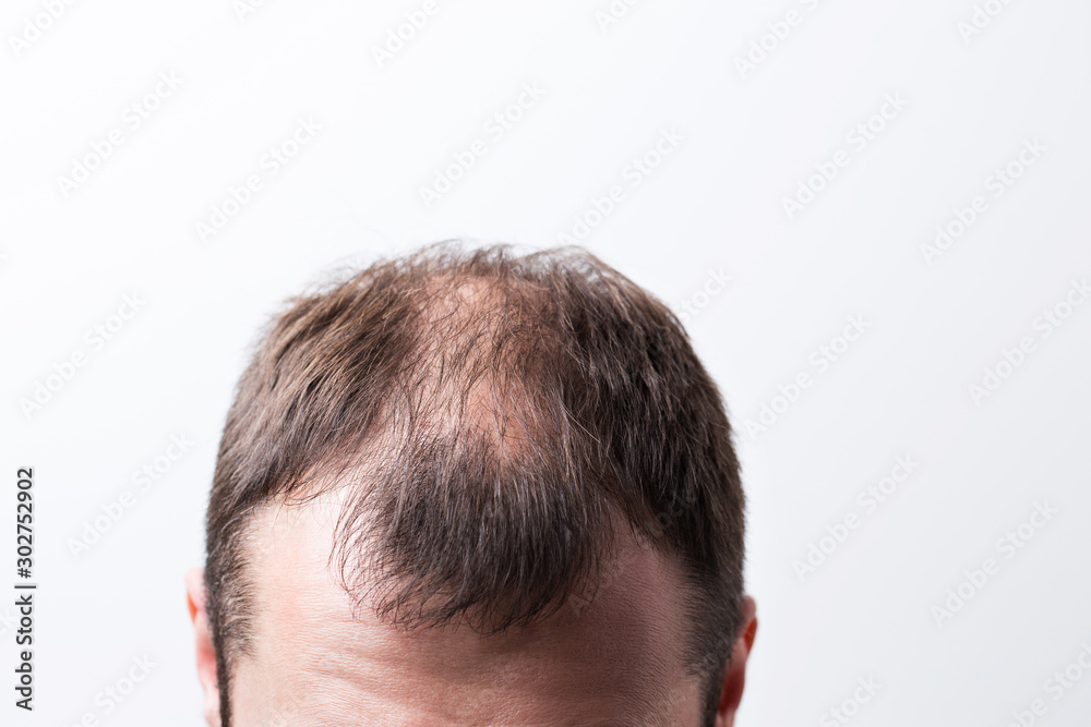 Close-up balding head of a young man on a white isolated background. Close-up balding head of a young man on a white isolated background.