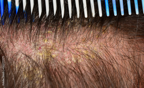 hair skin disease seborrea eczema photo
