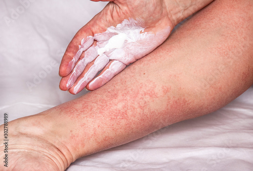 Allergic reaction treatment photo
