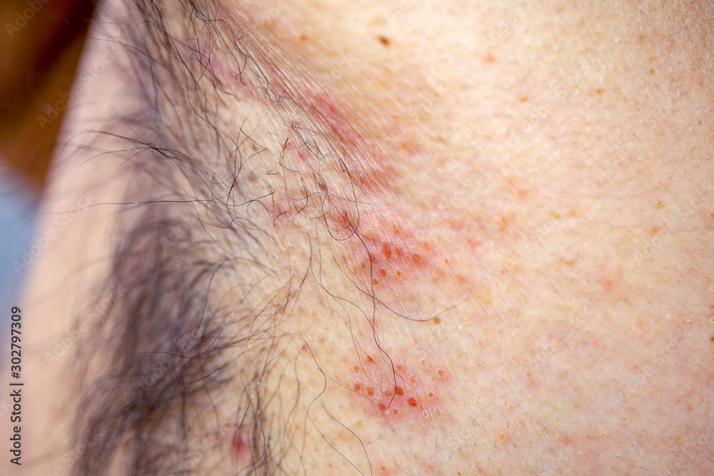 Naklejka premium Extreme close-up photography of the atocpic dermatitis symptoms on the left armpit of an adult male.