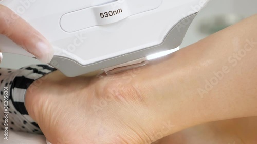 professional hands do laser anti-pigmentation procedure on woman ankle on medical clinic table extreme close-up photo