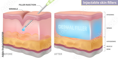 Injection filler injection under the skin, vector illustration photo