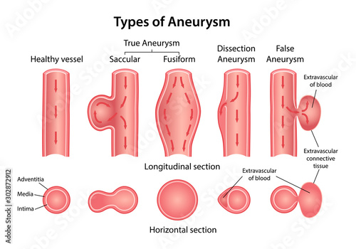 Types of aneurysm: True Aneurysm (Saccular, Fusiform), False and Dissection Aneurysms. Longitudinal and horizontal sections of blood vessels. Blood flow direction indicated. Vector illustration