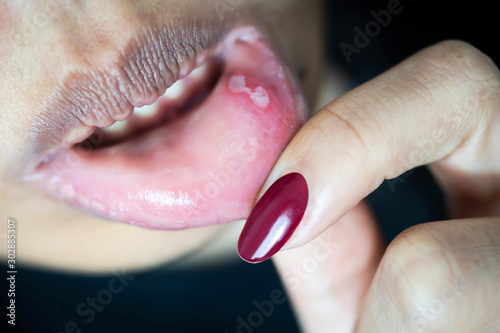 Woman having a swollen lower lip, caused by mouth ulcers