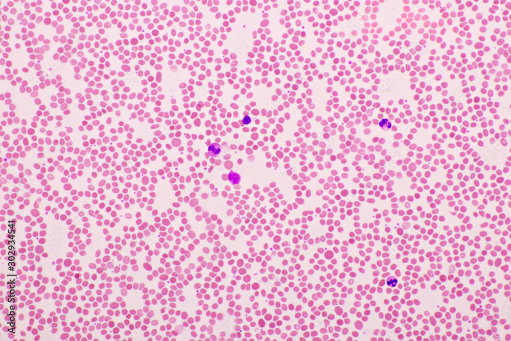 Picture of white blood cell, red blood cell and platelet in blood film ...