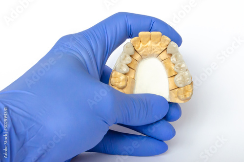 fake teeth. ceramic teeth. dental bridges. orthopedic dentistry. cermet bridges are on the gypsum model after manufacturing. plaster model with teeth in the dentist’s hand in a glove photo