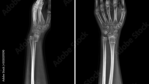 Film X ray wrist radiograph show wrist bone broken (torus or buckle fracture). The patient has wrist pain, swelling and deformity. Medical imaging and technology concept