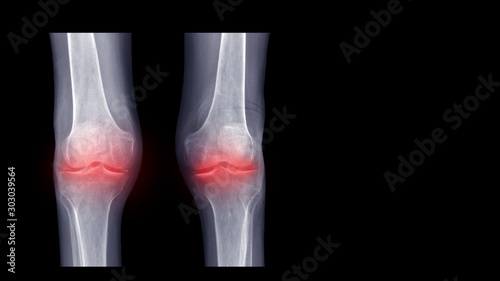 Film X ray knee radiograph show calcified meniscus from Pseudogout disease (Calcium pyrophosphate dihydrate crystal deposition or CPPD). Highlight on painful and arthritis area.  Medical image concept photo