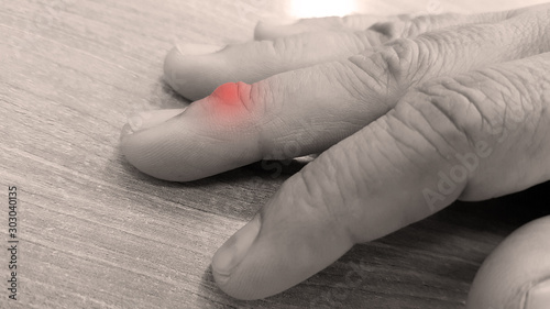 Ganglion cyst (synovial cyst disease) on middle finger. This cyst is fluid-filled bump associated with joint or tendon sheath. The patient has mass and pain on finger. Medical sign and symptom concept