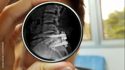Doctor‘s hand holding magnified lens its reflex of lens show film X ray of spinal stenosis disease treated by surgery (decompressive laminectomy with fusion and fixation with pedicle screw and rod). photo