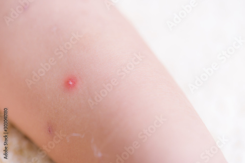 Kid have insect bites  mother applying antiallergic cream children knee