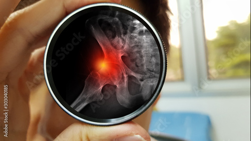 Orthopedic doctor‘s hand holding magnified lens and the reflex of lens show film X ray radiograph of FemoroAcetabular Impingement disease (FAI) or Hip impingement syndrome. medical technology concept  photo
