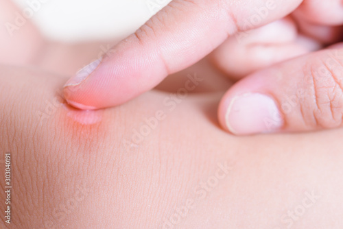 Mother applying antiallergic cream with red spot on knee of her kid