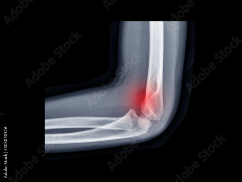 Canvas Print Film X-ray elbow radiograph show elbow bone broken (supracondylar of distal humerus fracture with fat pad sign) from fallen