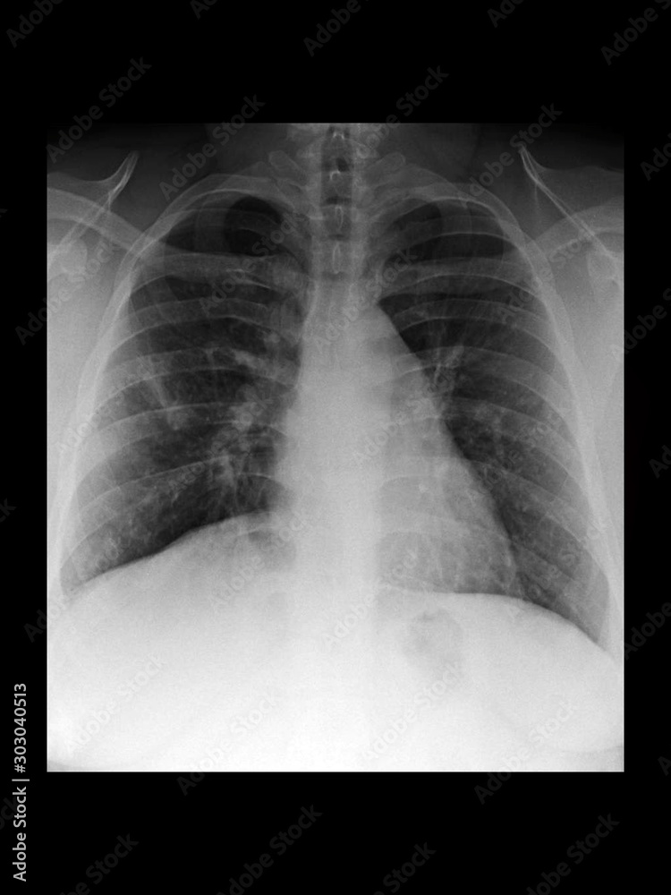 Atelectasis Chest X Ray